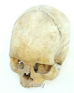 Antique XIXem child Medical Skull scientifique doctor Chester Stewart human bone