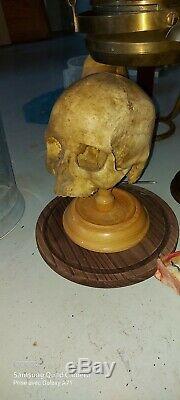 Antique XIXem child Medical Skull scientifique doctor Chester Stewart human bone