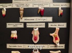 Teeth Model Museum Display Wax Tooth & Gum Disease Fine Berlin 1920