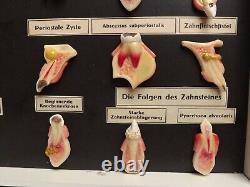 Teeth Model Museum Display Wax Tooth & Gum Disease Fine Berlin 1920
